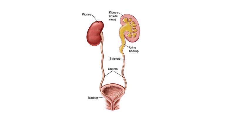 Ureteric Stone Treatment in Kaushambi