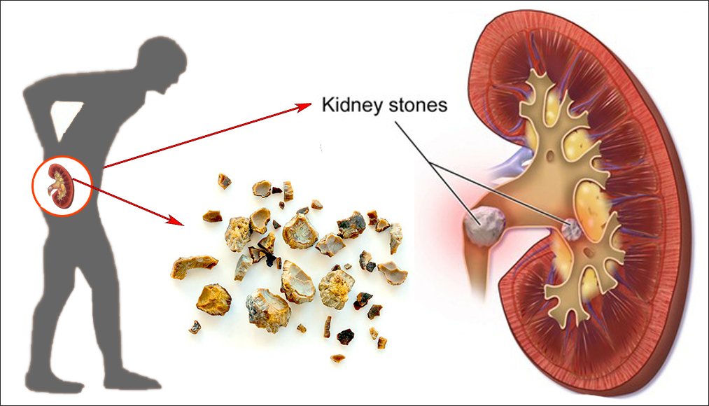Kidney Stone Treatment in Kaushambi
