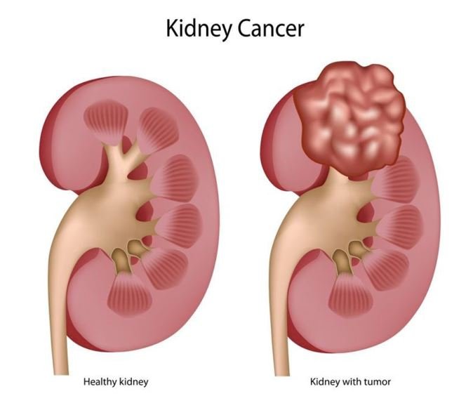 Kidney Cancer Treatment in Kaushambi