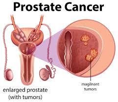 Prostate Cancer Treatment in Kaushambi