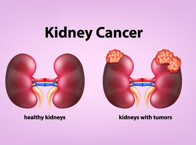 Kidney Cancer Treatment in Vaishali