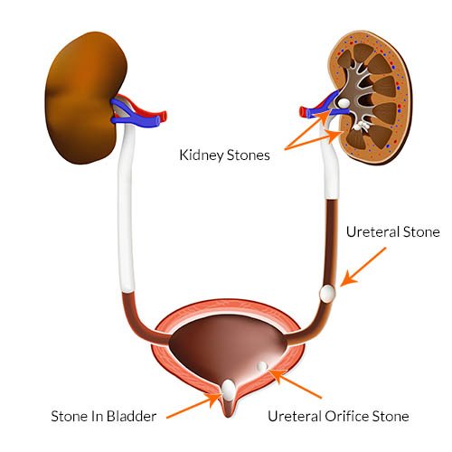 Ureteric Stone Treatment in Vaishali