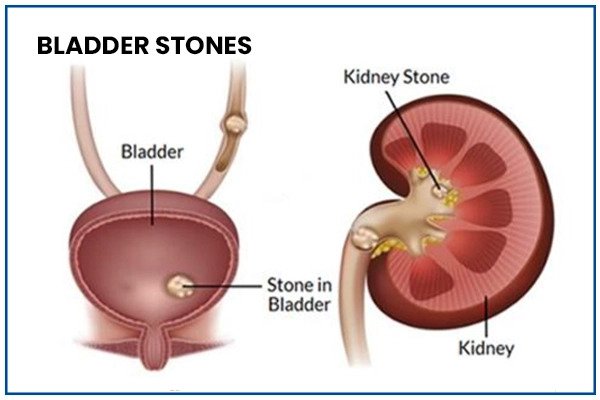 Bladder Stone Treatment in Vaishali
