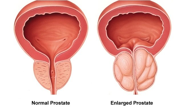 Prostate Enlargement Treatment in Vaishali