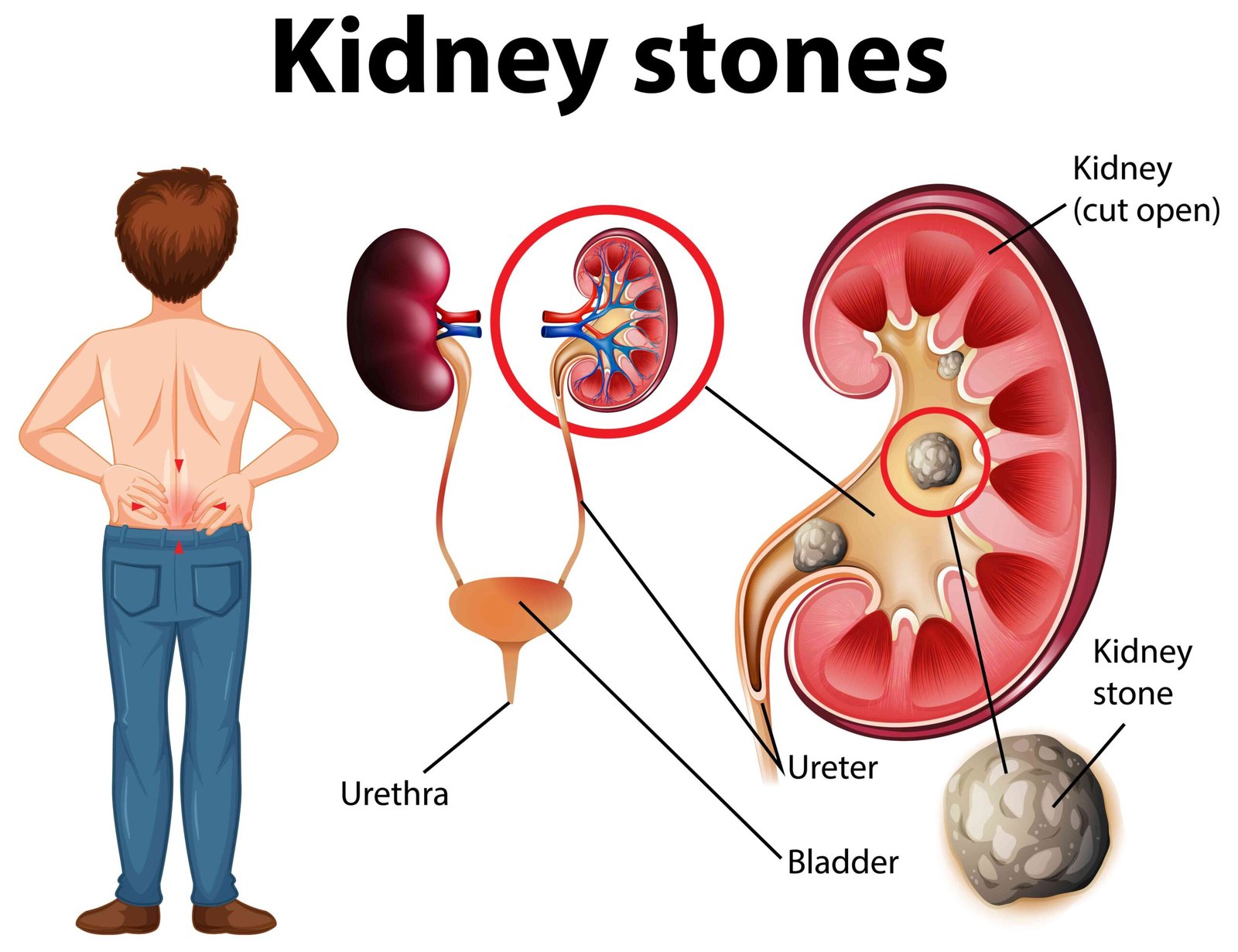 Kidney Stone Treatment in Ghaziabad