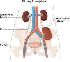 Kidney Transplant Surgery in Vaishali