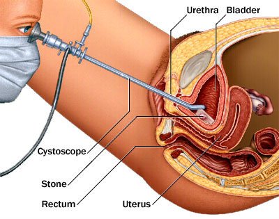 Bladder Stone Treatment in Ghaziabad