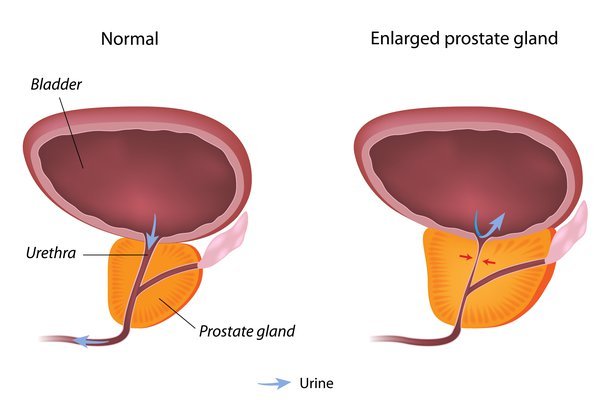 Prostate Enlargement Treatment in Ghaziabad