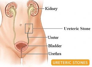 Ureteric Stone Treatment in Ghaziabad