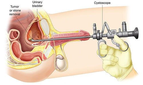 Best Prostate Enlargement Stone Treatment in Ghaziabad