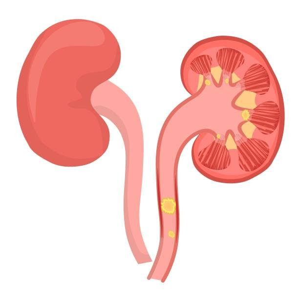 Best Ureteric Stone Treatment in Kaushambi