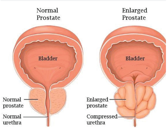 Best Prostate Enlargement treatment in Ghaziabad