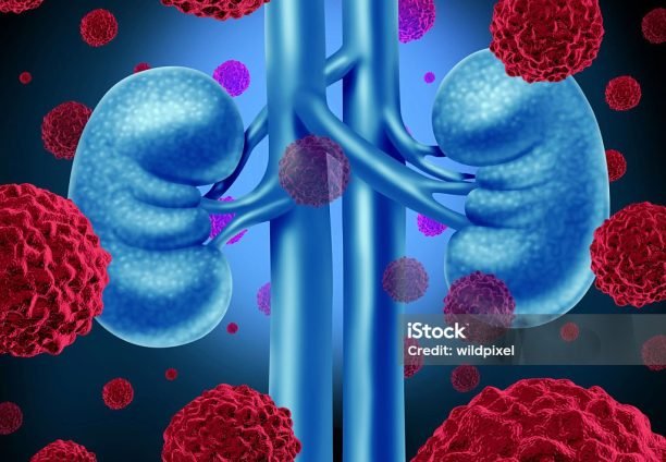 Kidney cancer medical concept as cancerouse cells in a human body attacking the urinary system and renal anatomy as a symbol for tumor growth treatment and risk.