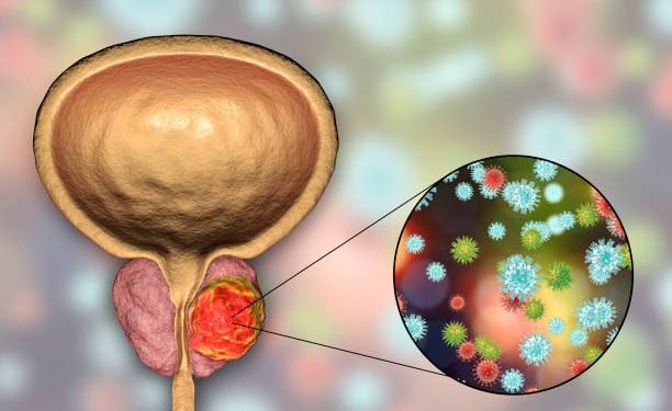 Conceptual image for viral ethiology of prostate cancer. 3D illustration showing viruses infecting prostate gland which develops cancerous tumor