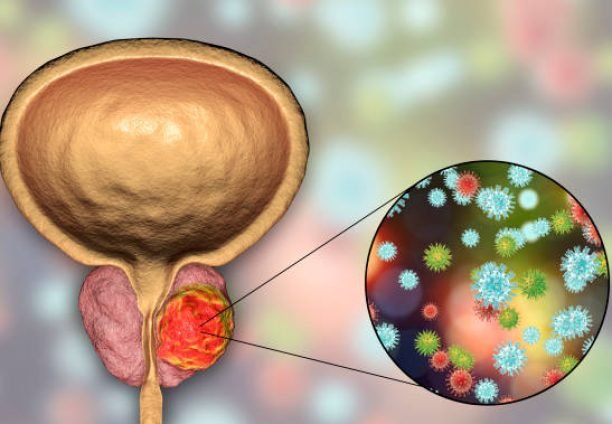 Conceptual image for viral ethiology of prostate cancer. 3D illustration showing viruses infecting prostate gland which develops cancerous tumor