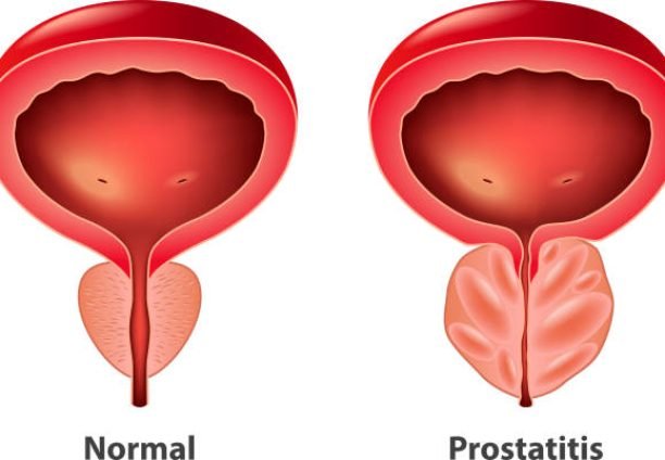 Prostatitis normal and inflamed prostate isolated vector photo-realistic illustration